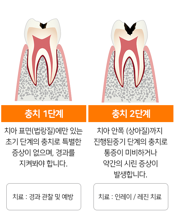 충치 1, 2단계