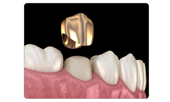 골드 크라운 치료