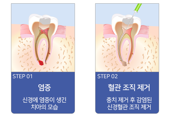 신경치료 진행과정-염증, 혈관조직 제거