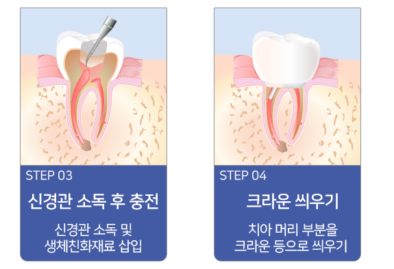 신경치료 진행과정-신경관 소독 후 충전, 크라운 씌우기