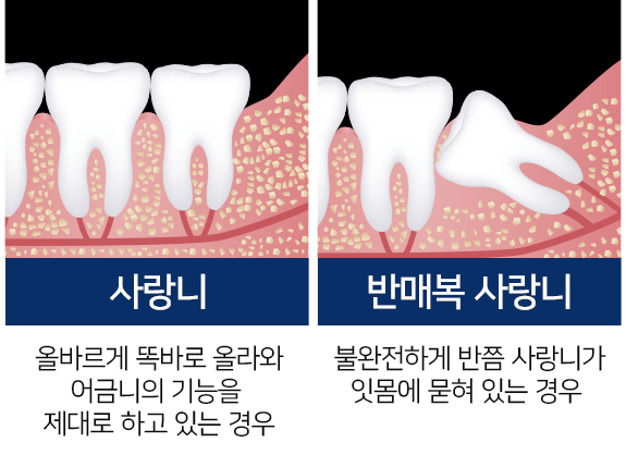 사랑니, 반매복 사랑니