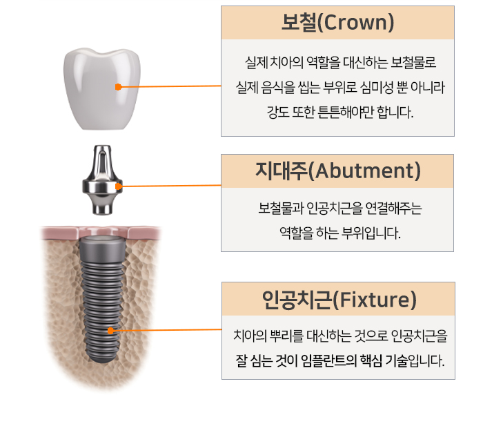 임플란트 보철, 지대주, 인공치근