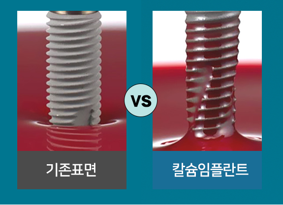 기존 임플란트 vs 칼슘임플란트