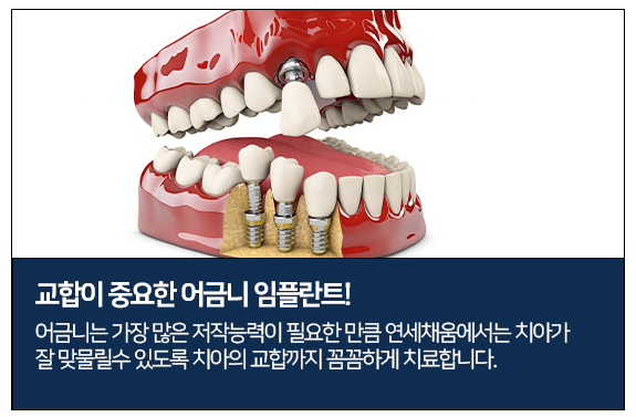 교합이 중요한 어금니 임플란트