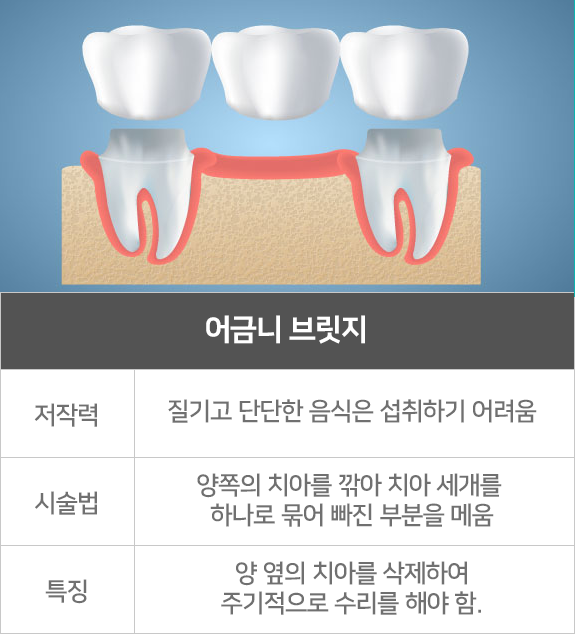 어금니 브릿지