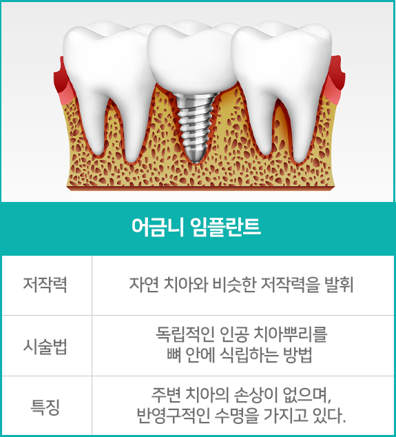 어금니 임플란트