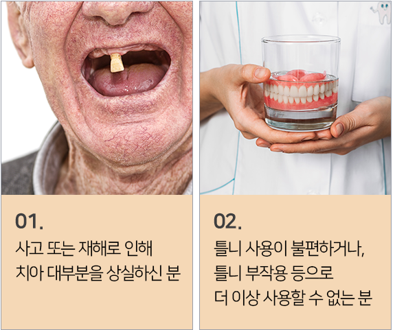 전체 임플란트가 필요한 경우1