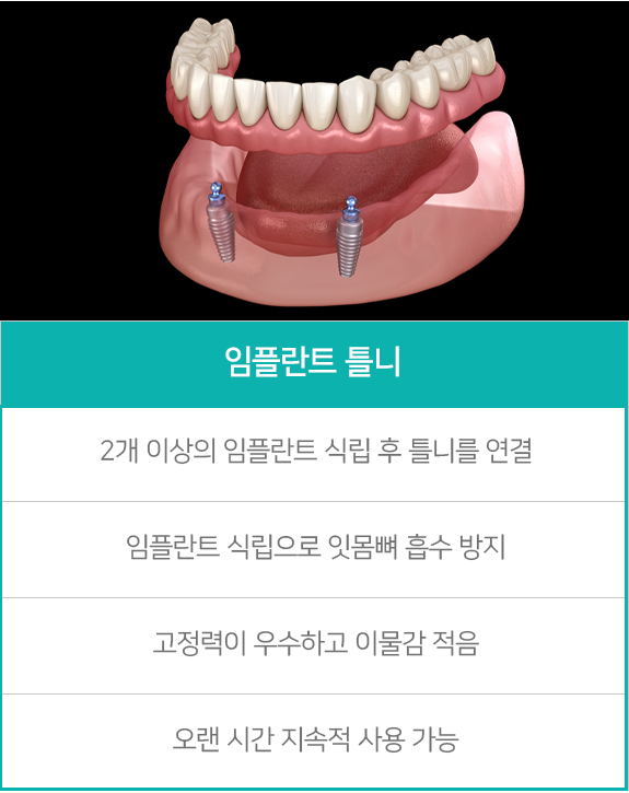 임플란트 틀니