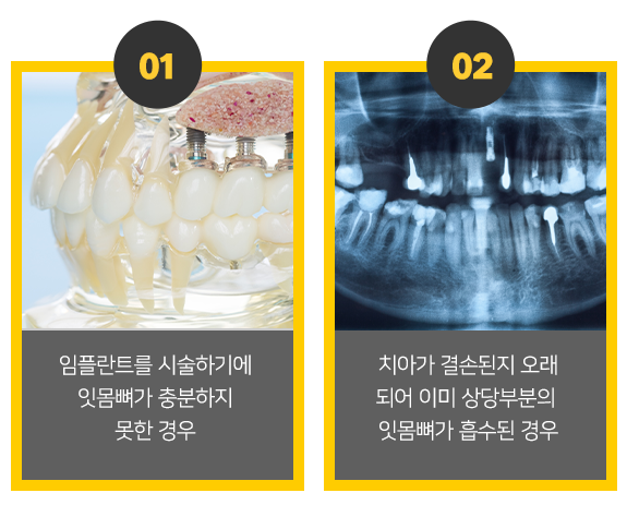 뼈이식이 필요한 경우1