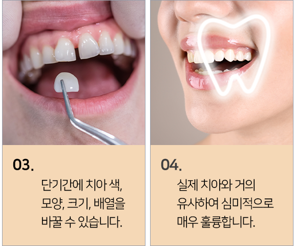 연세채움 올세라믹 장점2